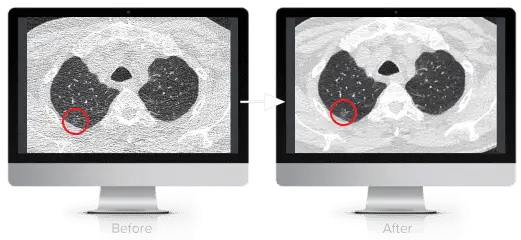 Facilitate Low Dose CT with PixelShine