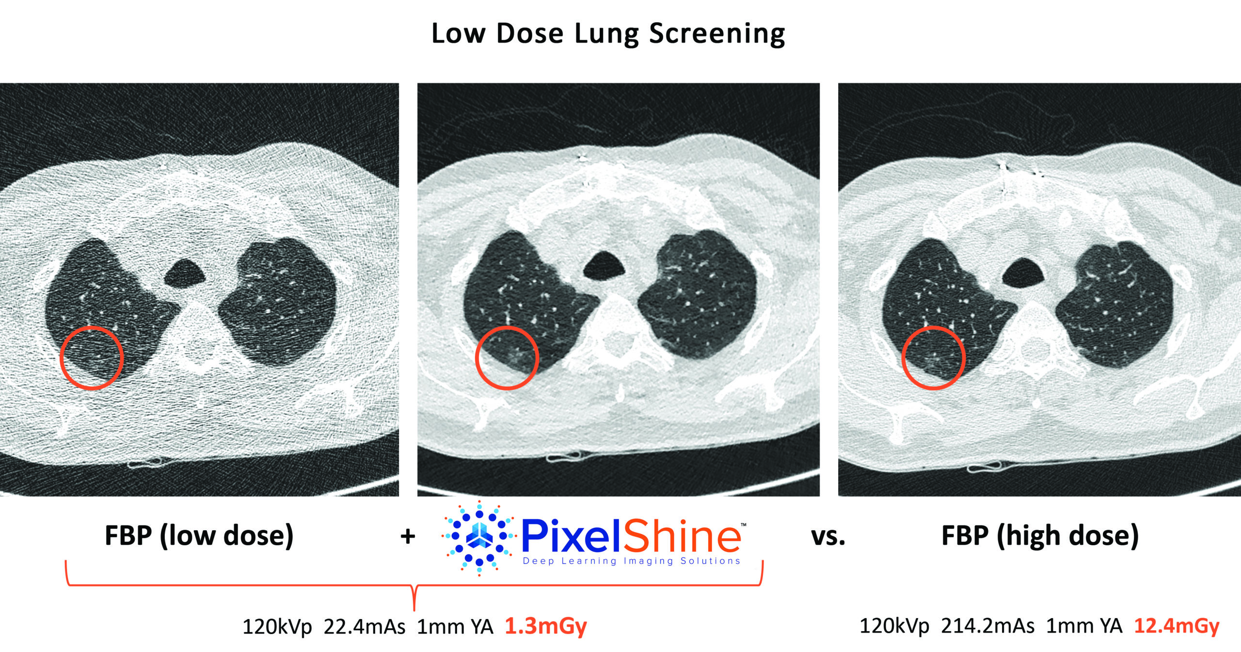 Pixelshine Low Dose Lung Screening