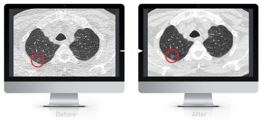 Facilitate Low Dose CT with PixelShine