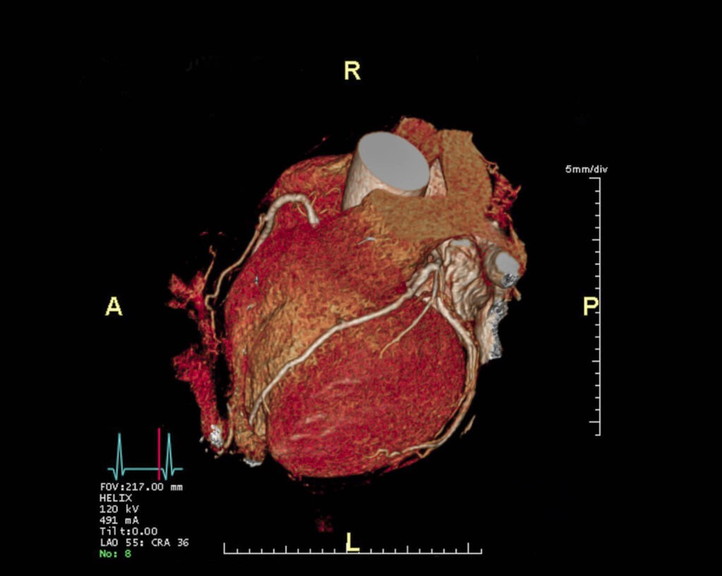 CTA Coronary artery 3D rendering image. CT angiography for heart Vessel disease .